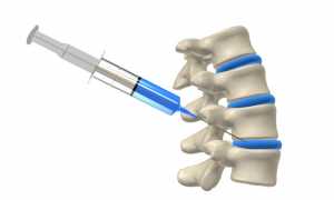 Дипроспан: блокада межпозвоночной грыжи
