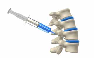 Дипроспан: блокада межпозвоночной грыжи