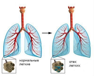 отек легких отек легких