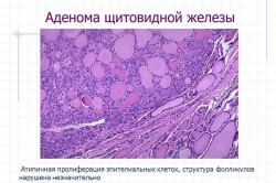 Схема аденомы щитовидной железы Схема аденомы щитовидной железы