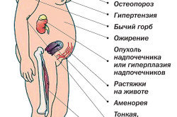 Симптомы болезни Иценко-Кушинга Симптомы болезни Иценко-Кушинга