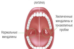 Хронический тонзиллит как осложнение после ангины Хронический тонзиллит как осложнение после ангины