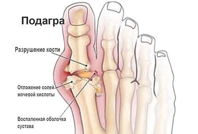 подагра подагра