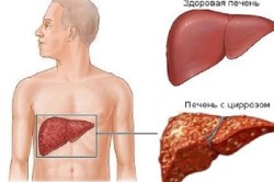Схема цирроза печени Схема цирроза печени