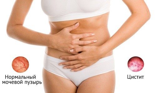 Цистит Цистит
