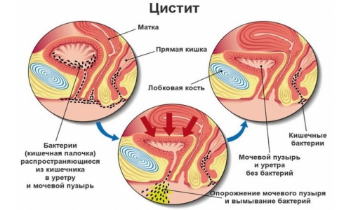 Проблема детского цистита Проблема детского цистита
