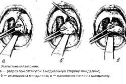 Этапы тонзиллэктомии Этапы тонзиллэктомии