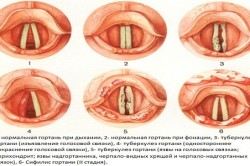 Схема проявления туберкулеза гортани Схема проявления туберкулеза гортани