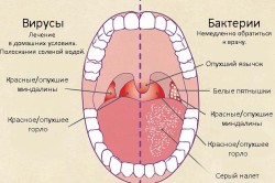 Инфекционные причины и признаки фарингита Инфекционные причины и признаки фарингита
