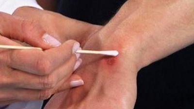 укус насекомого укус насекомого