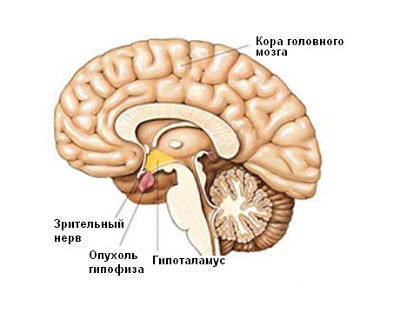 опухоль мозга опухоль мозга