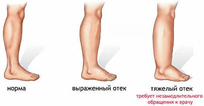 отеки отеки