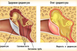 Отит - осложнение ангины Отит - осложнение ангины