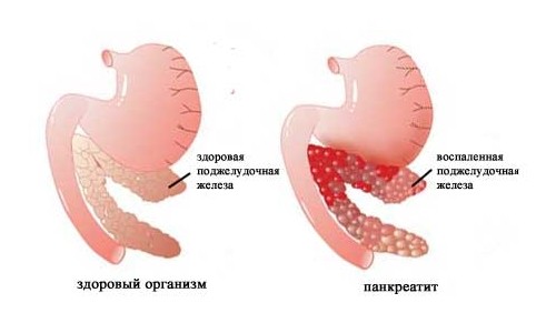 Схема панкреатита Схема панкреатита