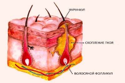 Как отличить лимфоузел от прыща