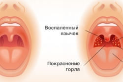 Признаки ангины Признаки ангины