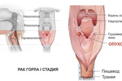 Опухоль в горле в виде шишки Опухоль в горле в виде шишки
