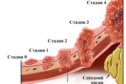 Стадии рака желудка Стадии рака желудка