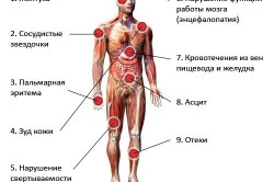 Симптомы заболевания печени Симптомы заболевания печени