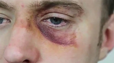 синяк под глазом синяк под глазом