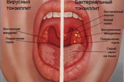 Виды тонзиллита Виды тонзиллита