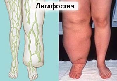 лимфостаз лимфостаз